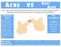 Aug 30, 2018 · how to get rid of sweat pimples (heat bumps) using natural remedies 1. What Is Butt Acne Treatment Options And Causes Of Butt Acne