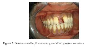 Resin Retained Bridge A Treatment Modality For Diastema Closure A Case Report Insight Medical Publishing