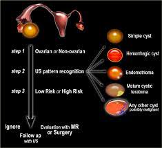 Symptoms of ovarian torsion include nausea, vomiting, and pain in the lower belly or pelvis. The Radiology Assistant Roadmap To Evaluate Ovarian Cysts