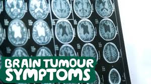 Cancer is defined as a group of diseases that have a wide range of causes. Symptoms Of Brain Tumour Macmillan Cancer Support