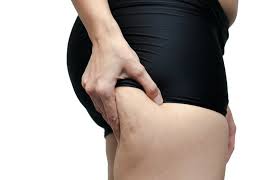 Cellulite is common and yet still incurable. Health Check What Is Cellulite