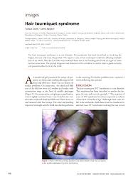 When applied for a longer time, tourniquets can cause permanent damage to muscles, nerves, and blood vessels. Pdf Hair Tourniquet Syndrome