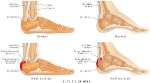 A patient's guide to haglund's deformity of the foot. Pin On Exercise