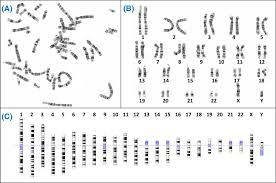 Two copies of the x chromosome produces a human female. The Genetic Basis Of Disease Abstract Europe Pmc