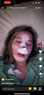 What Happens When You Get a Rhinoplasty Like Mia Blanchard? #MiaBlanchard  #Rhinoplasty