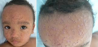 Papular crusted rash in a child after immunisation