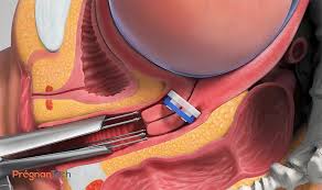 Anime, cartoon, animation cartoon, 3d Trendlines Pregnantech Developing Lioness Device To Prevent Preterm Birth Biotuesdays