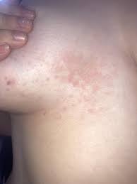 Image result for Inflammatory breast cancer