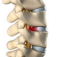 Bulging discs are sometimes also known as protruding discs. Bulging Disc Non Surgical Treatments Novus Spine Pain Center