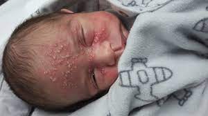 What You Must Know About Herpes Simplex Infection And Babies Motherhood In Style Magazine