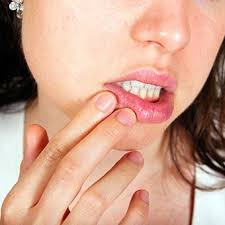 They can be quite distressing, painful and make the act of swallowing a bit cumbersome. How To Get Rid Of Canker Sores 14 Treatment Tips Causes
