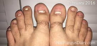 We did not find results for: Nail Fungus Update February 2016 Nail Fungus Diary