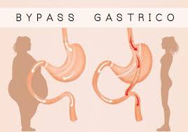 5 Types Of Weight Loss Surgeries You Should Know Weightloss And Wellness Center