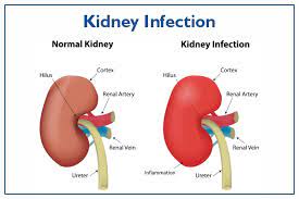 What Are The Kidney Infections- Symptoms | Medicover