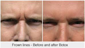 By now most everyone is familiar with botox/xeomin and how those injections can remove the wrinkles in between the eyebrows often referred to as the 11's. How To Reduce And Prevent Frown Lines Face Clinic London