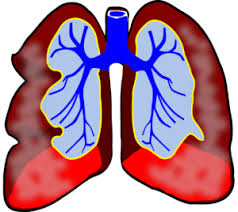 Thrombosis is the formation of a blood clot inside a blood vessel, obstructing the flow of blood through the circulatory system. Embolia Pulmonar Todo Lo Que Necesitas Saber Salud Diez
