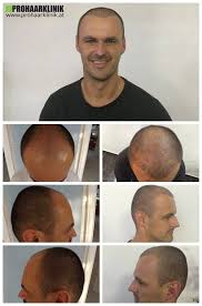haartransplantation vorher nachher bilder prohaarklinik