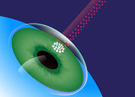 How old do you have to be to get lasik eye surgery in canada. Is There An Age Limit For Lasik Surgery Assil Eye Institute