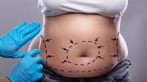 Abdominoplasty Tummy Tuck Surgery Prep And Recovery