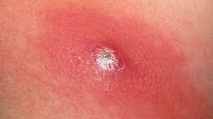 When it does, wash the affected area with soap and water and dress with a sterile bandage. Causes Symptoms And Treatment Of Skin Boils