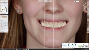 Mock Up Part 2 Digital Wax Up Using 3shape Dental System Dental Ear Cuff Wax