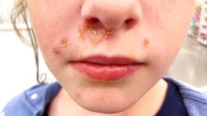 Image result for yellow scabs on the face in children
