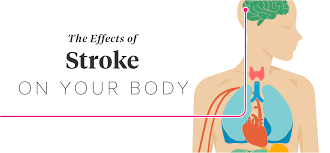 The Effects Of Stroke On The Body