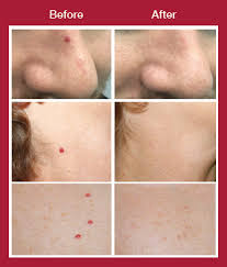 These are heredfitary and start to appear on the chest, back, and arms, usually in the 20's and beyond. Cherry Angiomas Removal Skinpossible Medical Aesthetics Clinic