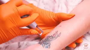 Our laser specialists have extensive experience removing all types of tattoos . Laser Tattoo Removal Skin Works Medical Spa Torrance Ca