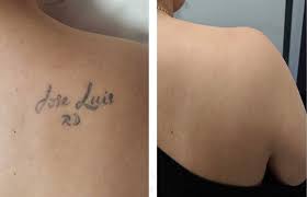 There is another variety of the best lasers for tattoo removal called picosecond lasers which work even better and faster. Los Angeles Tattoo Removal Laser Tattoo Removal