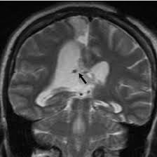A 73 Year Old Male With The Diagnosis Of Normal Pressure Hydrocephalus Download Scientific Diagram