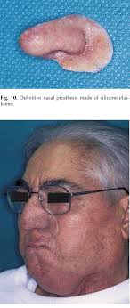 Lateral view of patient with intraoral and extraoral definitive...