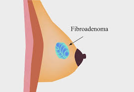 Signs and symptoms of multiple myeloma may include: Lump In Breast While Breastfeeding Types Treatment Prevention