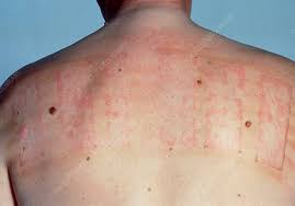 Image result for Patch Testing