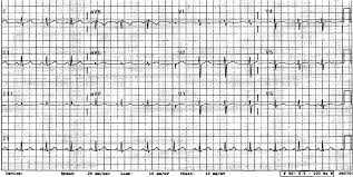 Image result for Cardiac Contusion