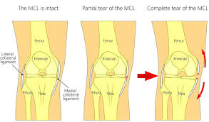Complete rupture of the ligament with significant swelling and with instability of the joint. Mcl Sprain Symptoms Grades Treatment Plan