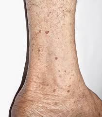 Image result for liver spots on legs