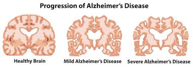 What You Should Know About Alzheimer's Disease