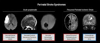 A stroke, or brain attack, occurs when blood circulation to the brain fails. Life After Perinatal Stroke Stroke