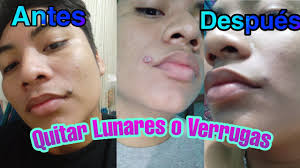 Remedio Casero Para Quitar Lunares De Carne Youtube