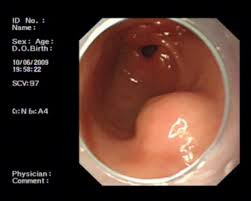 Image result for Glomus tumor