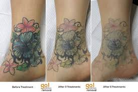 As science is progressing, tattoo removal has gained immense popularity. Tattoo Removal Takes Time This Series Shows The Progress Over About 16 Months From When The Client First Started Wi Tattoo Removal Laser Tattoo Removal Tattoos