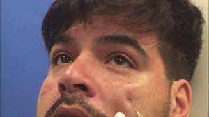 Non-Surgical Lower Eyelid Correction