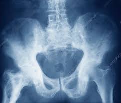Pelvis In Paget S Disease X Ray Stock Image C009 5394 Science Photo Library