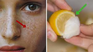 Freckles tend to appear larger when the clusters of spots overlap. Want To Remove Freckles Best Home Remedies To Get Rid Of Freckles Youtube
