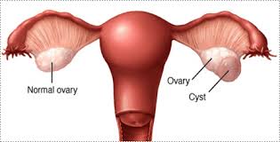 In some instances, a cyst will cause symptoms. Ovarian Cysts And Ovarian Cancer Alliance Obstetrics Gynecology Obstetricians