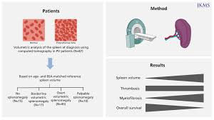 Image result for Splenomegaly