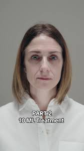 The overarching objective of Hayley's treatment was to address specific  areas of volume loss and profile balancing. I used 10 ML of varying  densities of Restylane dermal filler to her mid-face, ...