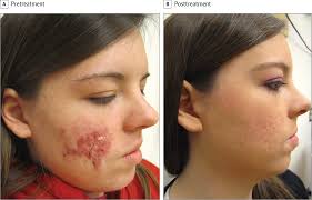 Accutane approximately 1 hour before sexual activity. How To Get Accutane Prescription Online Credit Card