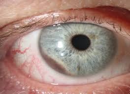 Image result for conjunctival melanoma